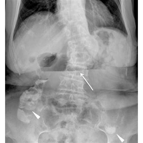 Plain Abdominal Radiography Performed At The Time Of Emergency