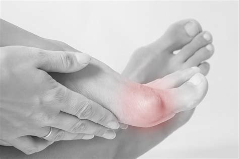 Recovering From Bunion Surgery Eugene Stautberg Md General