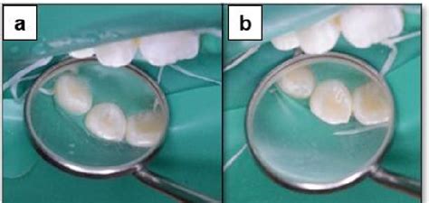 Figure 3 From Multiple Shovel Shaped Appearance Of Teeth Associated