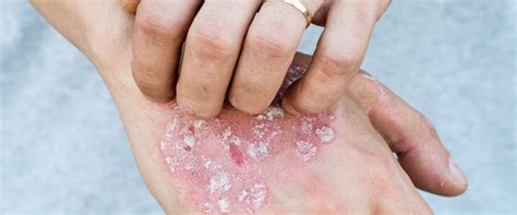 Identifying Your Rash Most Common Skin Rash Types