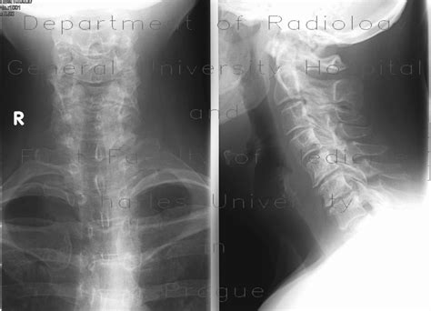 Radiology Case Fracture Of The Spinous Process C6 Clay Shovelers