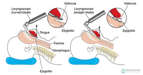 Epiglottic Vallecula A Key Landmark For Intubation 2024