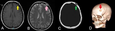Cavernous Hemangioma Of The Frontal Bone A Case Report Journal Of