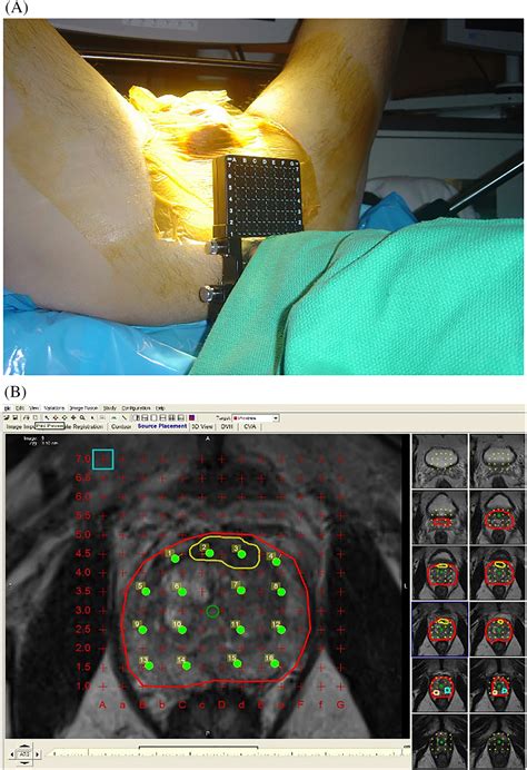 Performance Of Multiparametric Prostate Magnetic Resonance Imaging