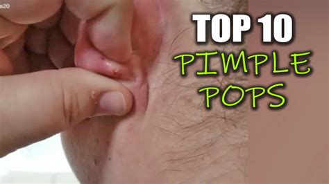 Pimple Pops Zits Mr Blackhead Dermatology And Whitehead Pops YouTube