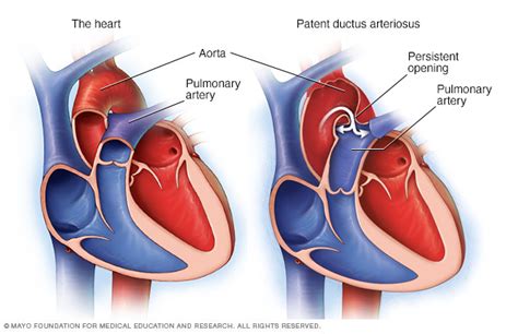 Patent Ductus Arteriosus Pda Beacon Health System