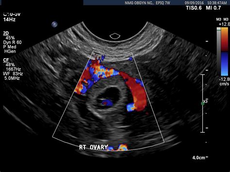 6 Week Transvaginal Ultrasound