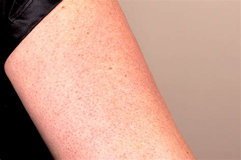 How To Get Rid Of Keratosis Pilaris Stubborn Red Bumps On