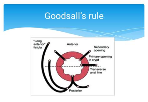 Goodsalls Rule Medizzy