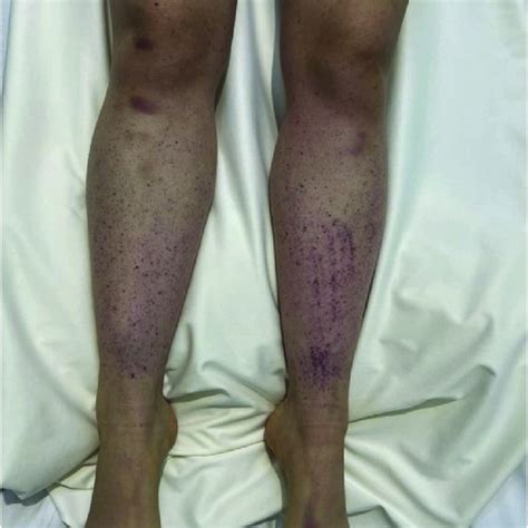 Purpuric Lesions On The Patients Lower Legs Download Scientific Diagram