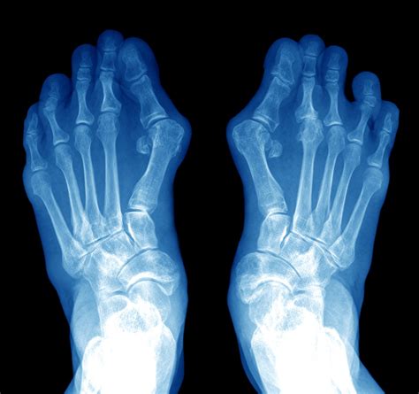 Bunions And Hammer Toes Foot And Leg Centre