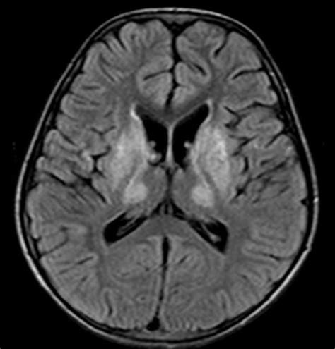 Wilson Disease Cns Manifestations Radiology Reference Article