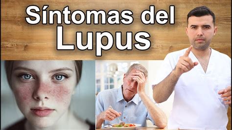 Síntomas Del Lupus Que Pocas Personas Conocen Youtube