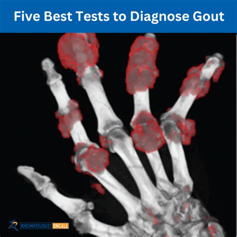 Best Tests For Gout Diagnosis Treatment