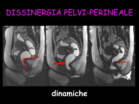 Ppt Imaging Della Pelvi Femminile Attualita Oncologica E Colon