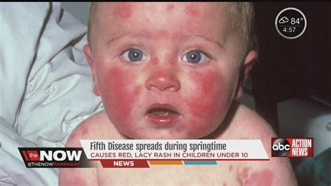 Pregnant Women Need To Be Aware Of A Common Virus Among Children During