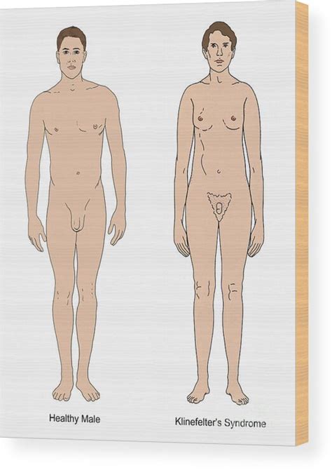 Klinefelters Syndrome Healthy Male Wood Print By Science Source