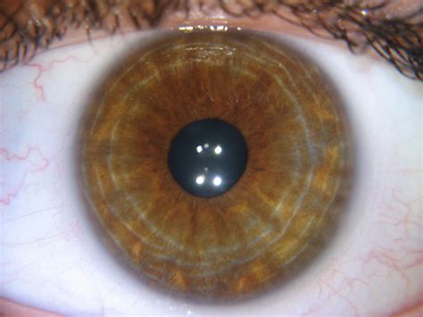 What And Why Iridology Yellow Ring Around Pupil？ Iriscope Iridology