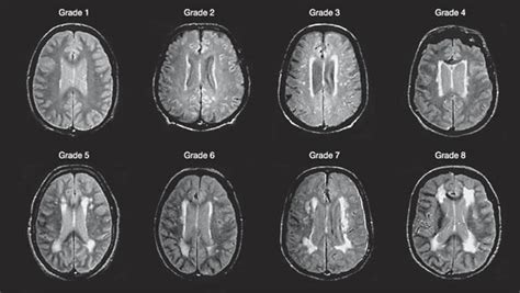 Cerebral White Matter Lesions Retinopathy And Incident Clinical