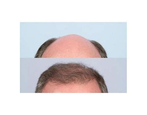 Bald Scalp Hair Transplant Before And After Photos