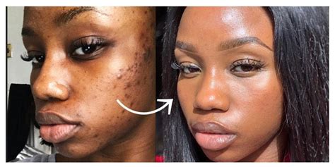 Turmeric Scrub Dark Spots Acne Smooth Glowing Skin Etsy