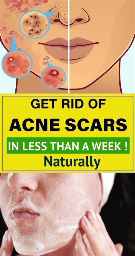 Pin On Back Acne Treatment