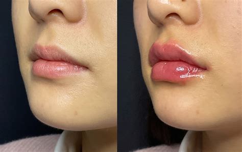 Cherry Lips Koreas Latest Lip Filler Trend Aer Skinlab