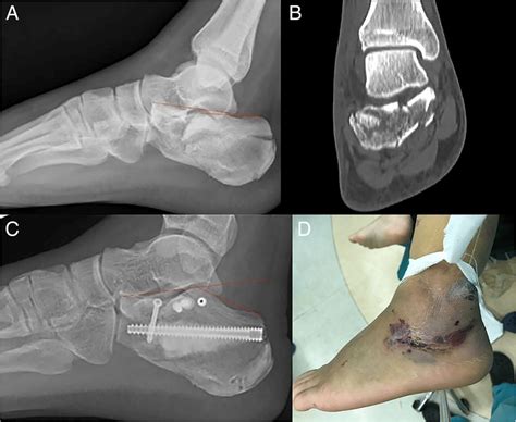 Case 1 A 40 Year Old Male With Diabetes And Severe Soft Tissue Injury Download Scientific