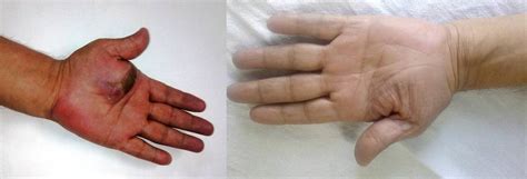 Tubercular Tenosynovitis Of Hand A Rare Presentation