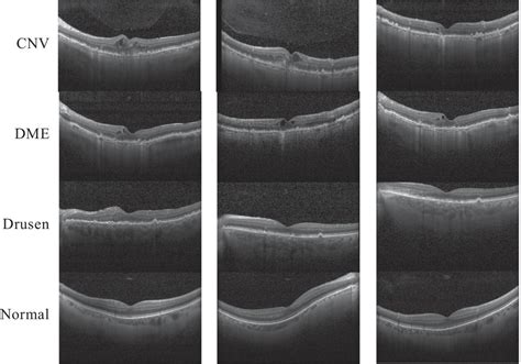 Representative Optical Coherence Tomography Images Of The Cnv Dme