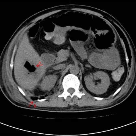 Ct Image Showing Liver Abscess Multiple Gas Accumulation And Dilation