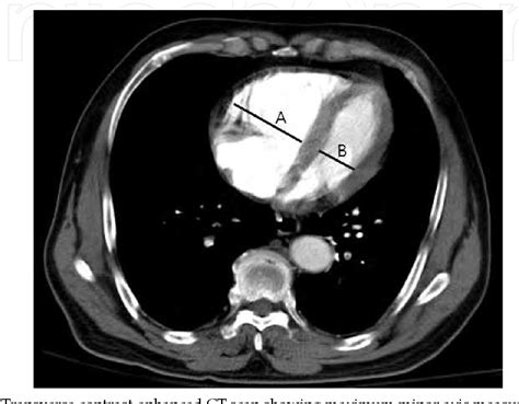 Figure 2 From Risk Stratification Of Submassive Pulmonary Embolism The