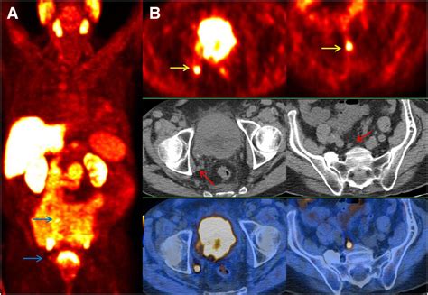Impact Of F Choline Pet Ct In Prostate Cancer Patients With Biochemical Recurrence Influence