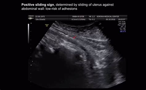 Understand the technical stuff of a digital image so you can make sideshow videos, reprints, and more! Sliding sign in third‐trimester sonographic evaluation of ...
