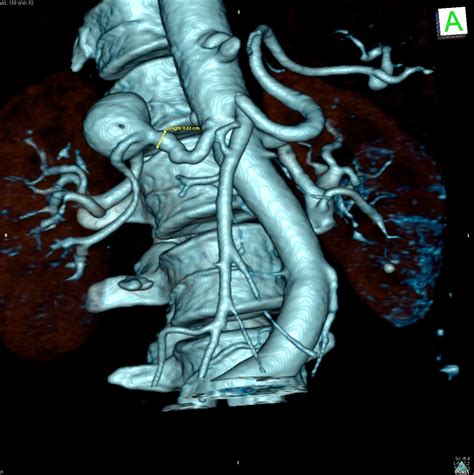 Aneurysms Of The Mesenteric Renal Splenic Arteries Sydney Medical