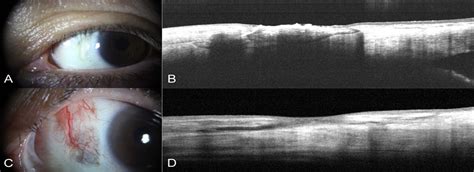 Long Term Clinical Outcomes Of Conjunctival Flap Surgery For Cornea