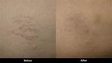 Pictures of Skin Discoloration After Laser Treatment