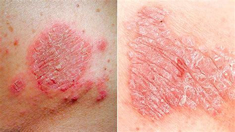 New Pain Free Test For Eczema And Psoriasis Everyday Health