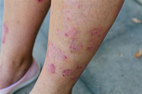Corporação Nebu Acoplador Red Spots On Legs Mímico Administração Artista