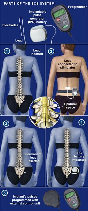 Spinal Cord Stimulator Implant The Southeastern Spine Institute
