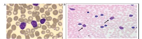 Peripheral Blood Smear From A Patient With Cll A Mature Appearing
