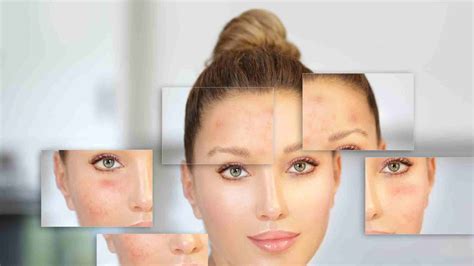 What Is Nodular Acne And Treatment Options Chooseclinic