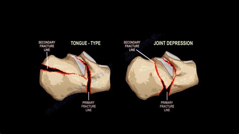 Calcaneal Fractures An Overview —
