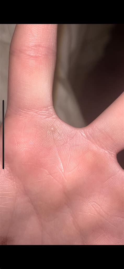 What Are These Bumps On My Boyfriends Hand They Are Smooth Painless