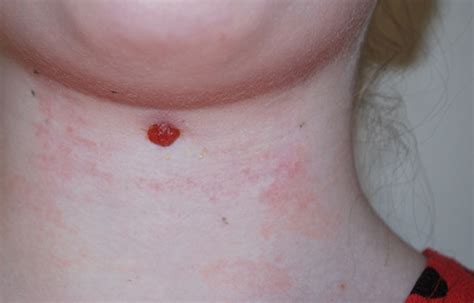 A Midline Neck Lump In A Child The Bmj