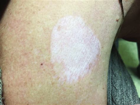 Hemorrhagic Bullous Ls After 15 Months Of Treatment With Topical