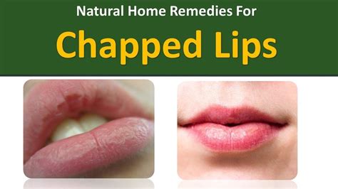Home Remedies For Chapped Lipssugar Honey Youtube