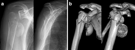 Right Proximal Humeral Fracture Of A 78 Year Old Woman The Humeral