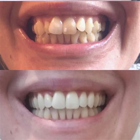 Before and after - 14 aligner trays and 13 refinement trays :D ...