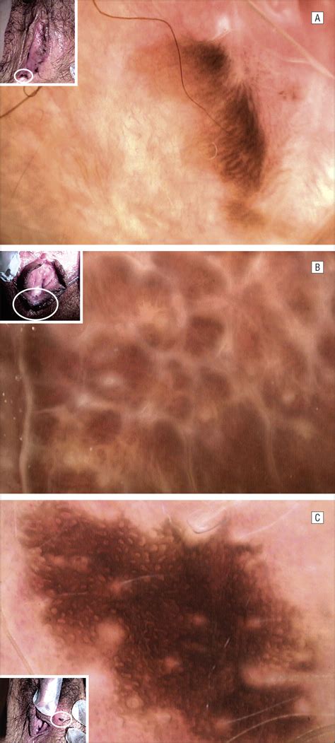 The Ringlike Pattern In Vulvar Melanosis A New Dermoscopic Clue For Diagnosis Dermatology
